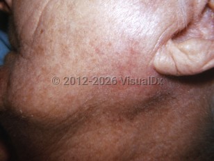 Parotitis