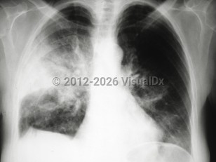 Acute eosinophilic pneumonia
