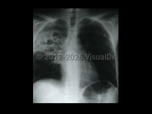Rhodococcus equi infection