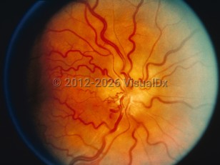 Ophthalmic Imaging image of Papilledema - imageId=6207488. Click to open in gallery. 