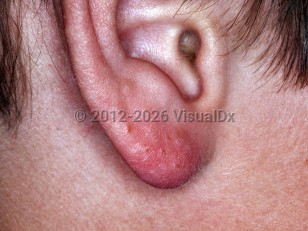 Clinical image of Juvenile spring eruption - imageId=6257294. Click to open in gallery.  caption: 'Tiny vesicles and crusts with background erythema on the earlobe.'
