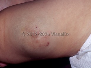 Venous malformation