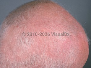 Clinical image of Graham-Little syndrome - imageId=636952. Click to open in gallery.  caption: 'Patchy scarring alopecia on the scalp.'
