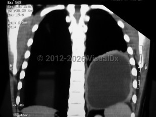 Echinococcosis