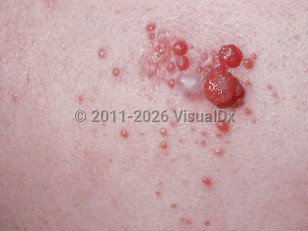 Clinical image of Solitary fibrous tumor - imageId=642368. Click to open in gallery.  caption: 'A close-up of a cluster of smooth and glistening red papules of varying sizes.'