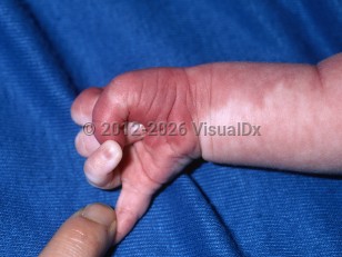 Clinical image of Sturge-Weber syndrome - imageId=6428124. Click to open in gallery.  caption: 'An extensive mottled, red patch on the arm and hand.'