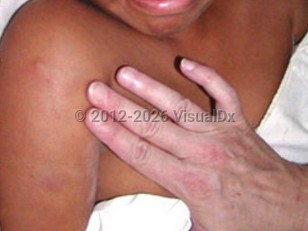 Pyomyositis