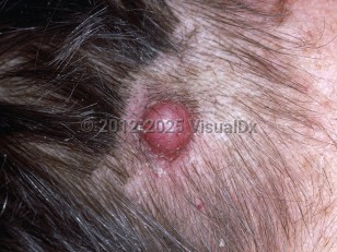 Clinical image of Cutaneous leiomyosarcoma - imageId=6511732. Click to open in gallery.  caption: 'A smooth dull pink nodule with overlying telangiectasias on the scalp.'