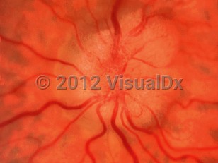 Ophthalmic Imaging image of Idiopathic intracranial hypertension - imageId=6552628. Click to open in gallery. 