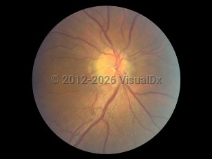 Ophthalmic Imaging image of Anterior ischemic optic neuropathy - imageId=6554314. Click to open in gallery. 