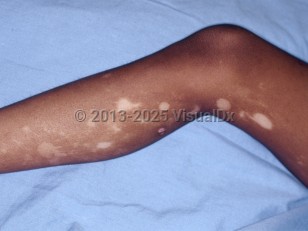 Clinical image of Segmental vitiligo - imageId=6581312. Click to open in gallery.  caption: 'Depigmented and hypopigmented macules and patches on the leg.'