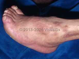 Clinical image of Poliomyelitis - imageId=6631792. Click to open in gallery. 