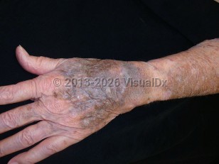 Clinical image of Amiodarone drug-induced pigmentation - imageId=6646942. Click to open in gallery.  caption: 'Deep blue and somewhat violaceous patches on the dorsal hand, and brown discoloration on the forearm, developing secondary to amiodarone.'