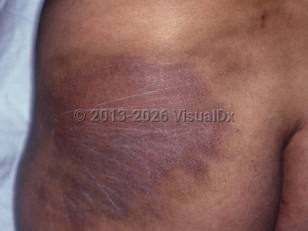 Clinical image of Paraffinoma - imageId=6716892. Click to open in gallery.  caption: 'Reddish-brown and violaceous plaques on the buttock.'