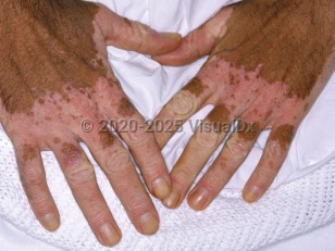 Clinical image of Chemical leukoderma - imageId=6717440. Click to open in gallery.  caption: 'Depigmented patches with a pinkish hue on the dorsal hands and fingers, secondary to a phenolic detergent. Note the confetti macules at the proximal patch edges.'