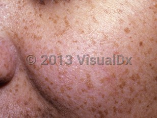 Clinical image of Ephelides - imageId=6736522. Click to open in gallery.  caption: 'Myriad tan macules on the face.'