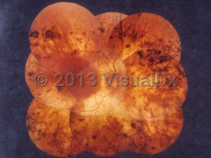 Ophthalmic Imaging image of Retinitis pigmentosa - imageId=6769507. Click to open in gallery. 