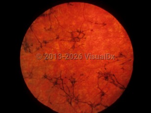 Ophthalmic Imaging image of Usher syndrome - imageId=6773539. Click to open in gallery.  caption: 'Retinitis pigmentosa appearing as pigmentary clumping into a bony spicule formation, with severe attenuation of the retinal vessels.'