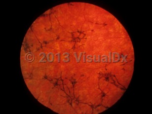 Ophthalmic Imaging image of Usher syndrome - imageId=6773539. Click to open in gallery.  caption: 'Retinitis pigmentosa appearing as pigmentary clumping into a bony spicule formation, with severe attenuation of the retinal vessels.'