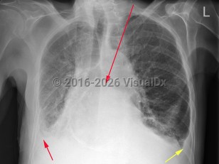 Congestive heart failure