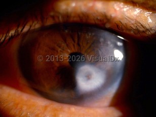Ophthalmic Imaging image of Peters anomaly - imageId=6790350. Click to open in gallery.  caption: 'A paracentral corneal scar (leukoma).'