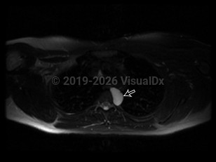 Imaging Studies image of Bronchogenic cyst - imageId=6831484. Click to open in gallery.  caption: '<span>Axial MRI image of the chest demonstrates a circumscribed lesion in the left posterior  mediastinum which is intermediate in intensity on T1 and hyperintense on  T2 consistent with a proteinaceous cyst (straight black arrow).</span>'