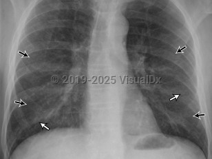 Imaging Studies image of Extrinsic allergic alveolitis - imageId=6832895. Click to open in gallery.  caption: '<span>Radiographs show hazy  opacities throughout both lungs (straight black arrows). Small, poorly  defined nodules are subtle (straight white arrows). There is relative  sparing of the lung apices. Patient is a 63 year-old male with history of exposure to birds, presenting with low-grade fever and shortness of breath.</span>'