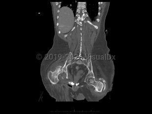 Septic arthritis
