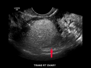 Imaging Studies image of Ovarian cysts - imageId=6839868. Click to open in gallery.  caption: 'Image from a transvaginal ultrasound demonstrating a highly echogenic mass in the right ovary, consistent with a dermoid cyst.'
