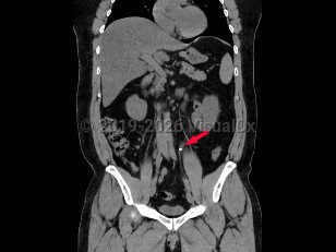 Imaging Studies image of Ureteral calculus - imageId=6841846. Click to open in gallery.  caption: '<span>Coronal image from unenhanced CT scan of abdomen and pelvis with left ureteral calculus in 47 year old male.</span>'