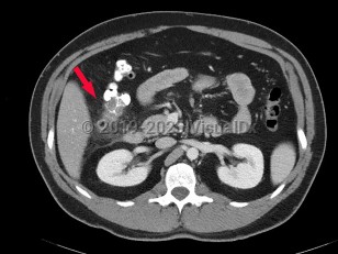 Imaging Studies image of Diverticular disease - imageId=6841976. Click to open in gallery.  caption: '<span>Axial image from CT scan of  abdomen and pelvis with wall thickening of ascending colon, with an  inflamed diverticulum consistent with diverticulitis.</span><br />'