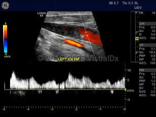 Internal jugular vein thrombosis