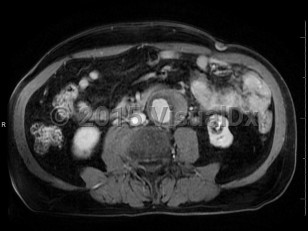 Imaging Studies image of Abdominal aortic aneurysm - imageId=6846307. Click to open in gallery.  caption: '<span>Axial CT image demonstrates an abdominal aortic aneurysm with mural thrombus</span>.'