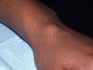 Ganglion cyst