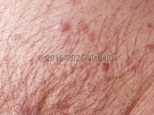 Clinical image of Non-Hodgkin lymphoma - imageId=69370. Click to open in gallery.  caption: 'A close-up of numerous smooth, dull, pink papules.'