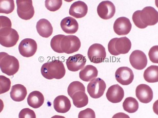 Babesiosis