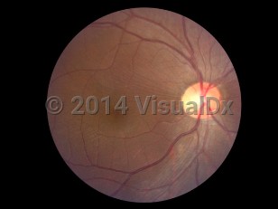 Ophthalmic Imaging image of Macular pucker - imageId=7171019. Click to open in gallery. 