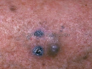 Clinical image of Metastatic cutaneous melanoma - imageId=731135. Click to open in gallery.  caption: 'A close-up of a cluster of black and deep gray papules, and background sun-damaged skin.'