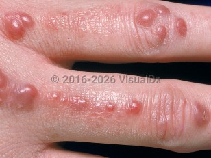 Clinical image of Multicentric reticulohistiocytosis - imageId=737762. Click to open in gallery.  caption: 'Numerous smooth, red and maroon papules on the dorsal fingers.'