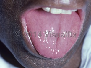 Clinical image of Vitamin B2 deficiency - imageId=7395462. Click to open in gallery.  caption: 'Atrophic glossitis.'