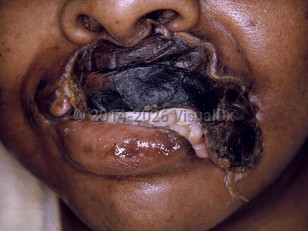 Clinical image of Noma - imageId=7395913. Click to open in gallery.  caption: 'An extensive eschar on the upper and lateral lip with loss of tissue around it.'