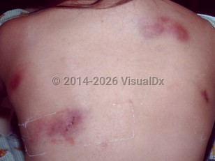Alpha-1 antitrypsin deficiency