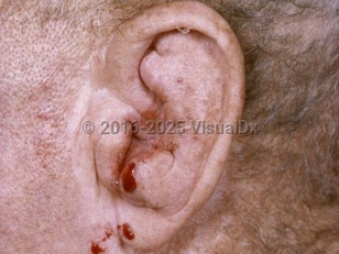 Clinical image of Perichondritis - imageId=7407461. Click to open in gallery.  caption: 'Marked swelling and deformity of the cartilage of the ear.'