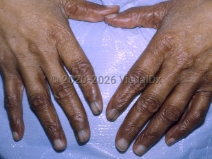 Pernicious anemia