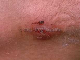 Clinical image of Neurothekeoma - imageId=748849. Click to open in gallery.  caption: 'A close-up of an ill-defined erythematous nodule with a central erosion.'