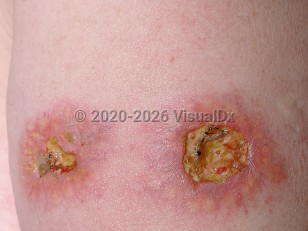 Clinical image of Necrobiotic xanthogranuloma - imageId=749279. Click to open in gallery.  caption: 'A close-up of ulcerated and crusted, yellowish and pink plaques, on the upper arm.'