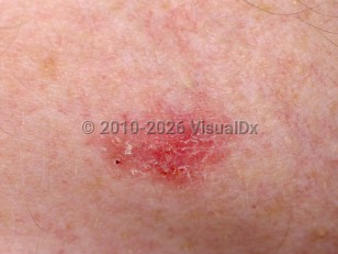 Clinical image of Superficial basal cell carcinoma - imageId=75190. Click to open in gallery.  caption: 'A close-up of a deep pink plaque with some overlying scale.'