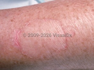 Clinical image of Porokeratosis (linear, Mibelli, plantar, ptychotropica) - imageId=768088. Click to open in gallery.  caption: 'A close-up of porokeratosis of Mibelli showing thin, atrophic plaques, each with a peripheral thin ridge of scale.'
