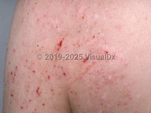 Clinical image of Pediculosis corporis - imageId=769280. Click to open in gallery.  caption: 'Numerous excoriated papules, some bleeding, on the upper arm and lateral back.'