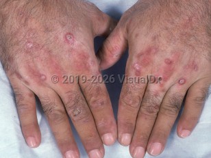Clinical image of Porphyria cutanea tarda - imageId=775172. Click to open in gallery.  caption: 'Crusted erosions and erythema on the dorsal hands and fingers.'